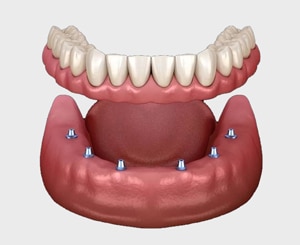 DENTURE-implant-placed
