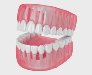 SCREW-RETAINED-DENTURE-attached