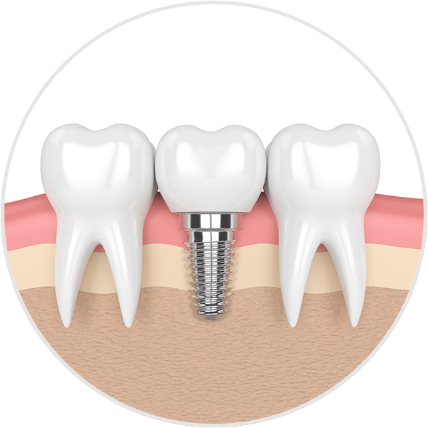 dental-implant-illust-circle