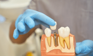 Dental Implants