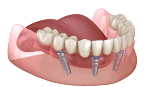 Implant Supported Overdentures
