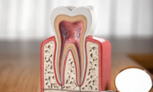 Root Canal Treatment