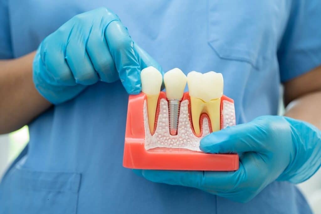 How To Choose The Right Dental Implant Dentistry?