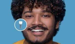 What I have to do after Dental Implant Treatment?