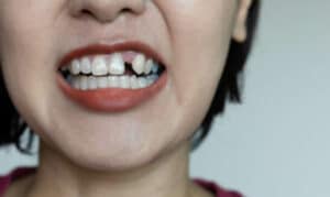 replace missing teeth