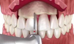 crown lengthening process