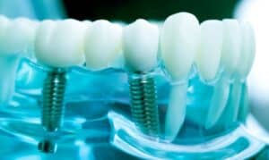 Dental Implants Decoded: State-of-the-Art Tooth Replacement in Livermore