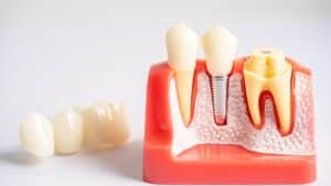 Dental Implants and Bone Health: A Symbiotic Relationship