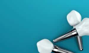 downside of all on 4 dental implants