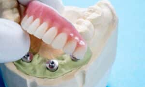 Does food get stuck under all on 4 dental implants?