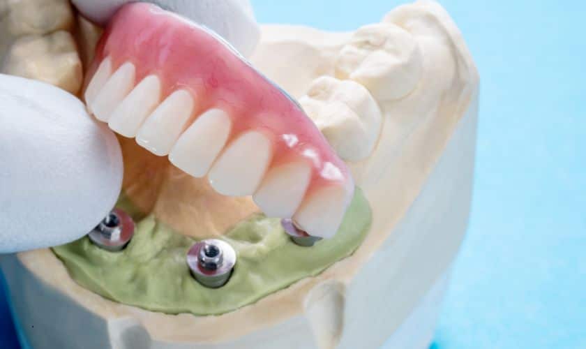 Does food get stuck under all on 4 dental implants?