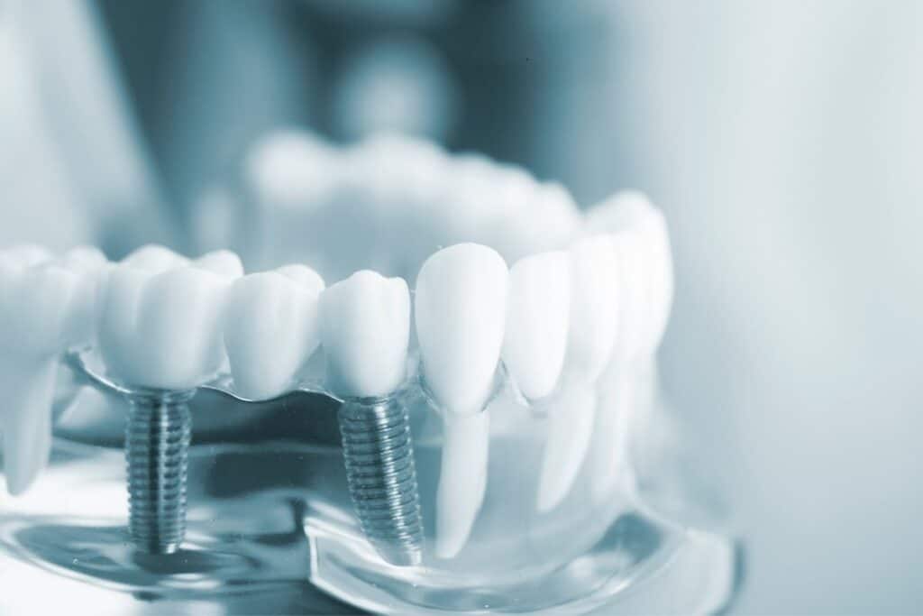 How do you clean under all 4 dental implants
