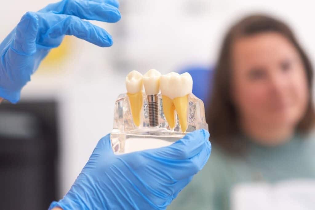 Are All-on-4 Dental Implants Worth the Hype