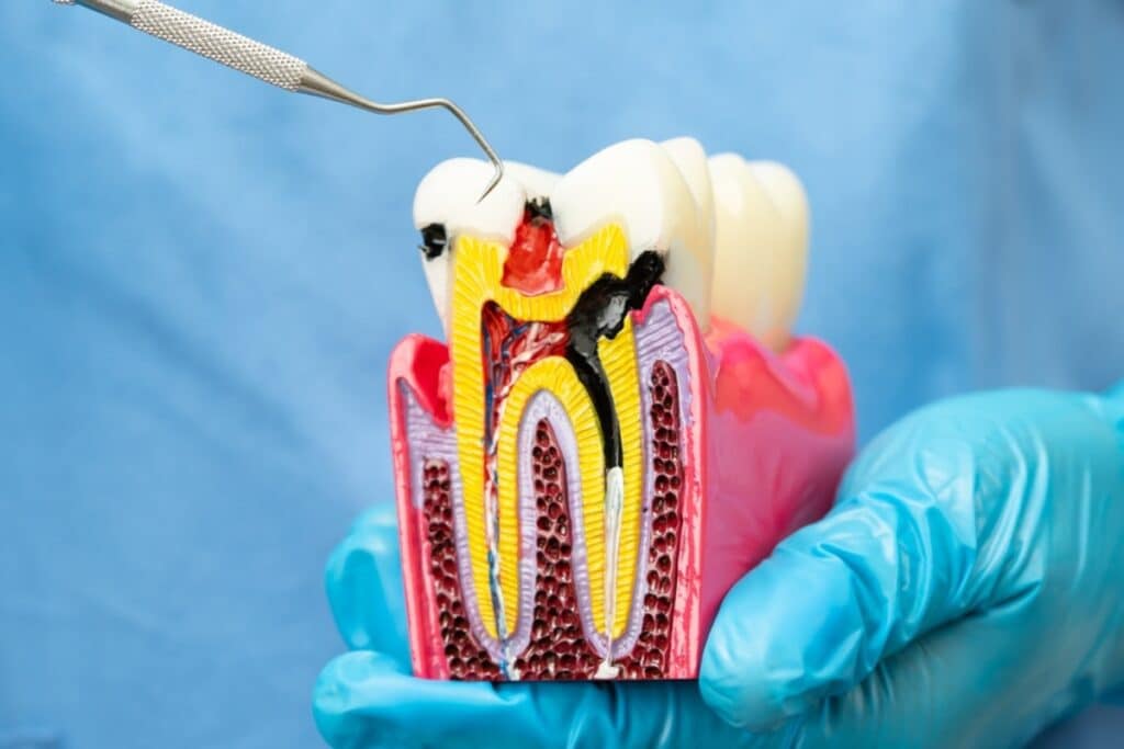 Root canal