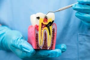 Root Canal Treatment In Livermore