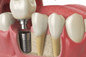 How Dental Implants Work: Step By Step