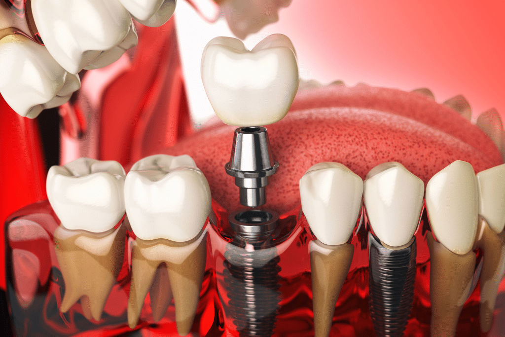 dental implant in Livermore