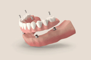 all on 4 dental implants Livermore