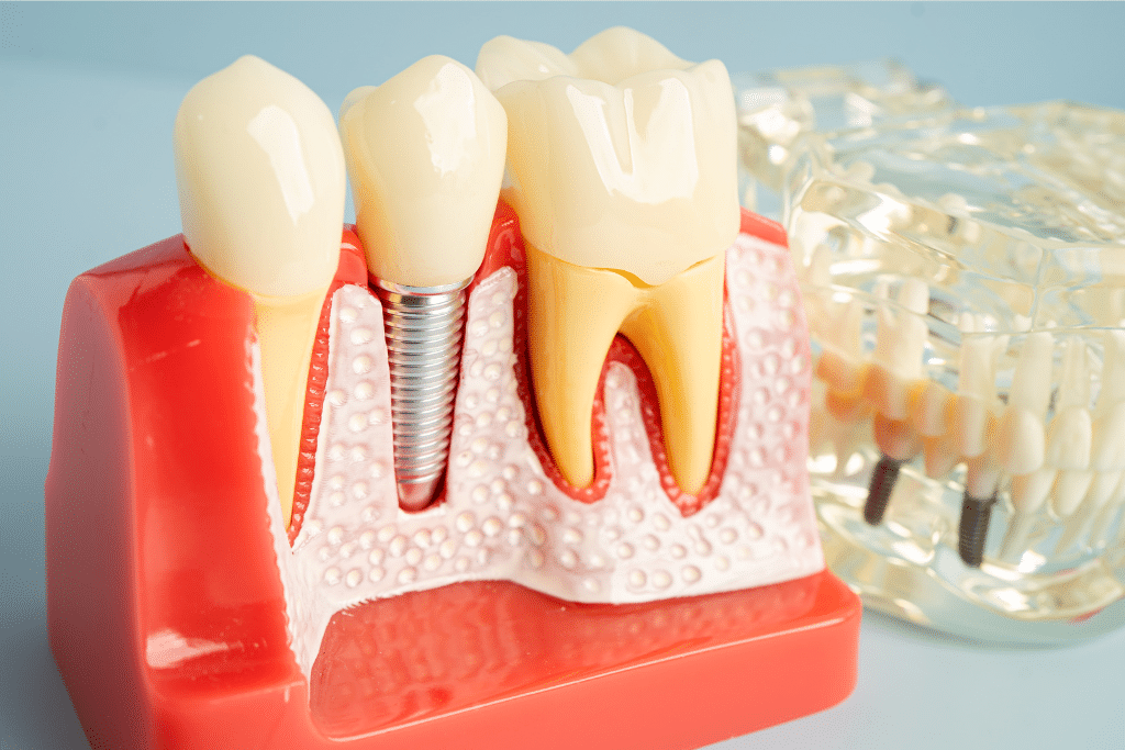 implant dentist in Livermore