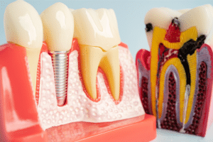 all on 4 dental implants in Livermore