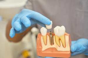 dental implants in Livermore