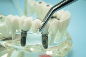 all on 4 Dental Implants in Livermore