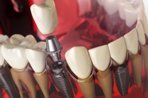 all on 4 Dental Implants in Livermore