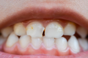Emergency Dentistry in Livermore