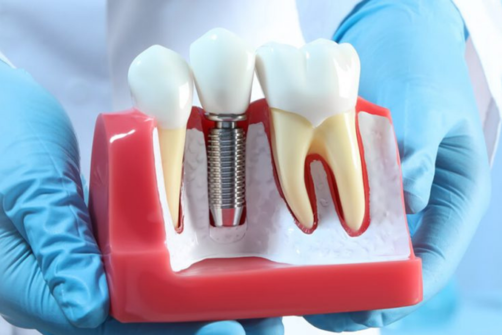 Dealing With Loose Dentures? Consider Dental Implants
